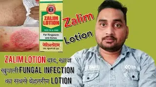 Zalim Lotion दाद,खाज,खुजली Fungal infection का सबसे बेहतरीन Lotion..[Rahul Pharma Clinic]