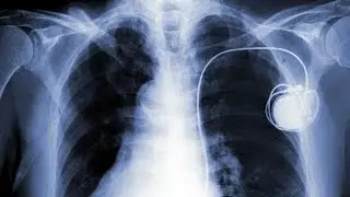Human Physiology - Pacemaker Activity