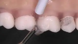TUTORIAL Inserts Prophylaxie et traitement&ndash; ACTEON