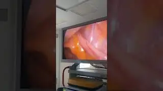 Rare case strangulated femoral hernia with  appendix.Ущемленная бедренная грыжа с аппендиксом