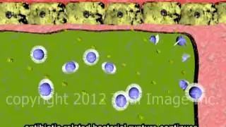 Bacterial Meningitis Antibiotic Therapy video - Animation by Cal Shipley, M.D.