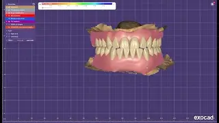 Fmr  - designing for single piece implant in exocad