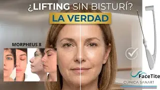 Facetite o MiniLifting sin cirug&iacute;a?? Dr Godoy 