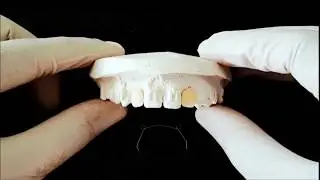 Fabrication of bondable pontic retainer - Journal of Clinical Orthodontics - JCO MAR 2018