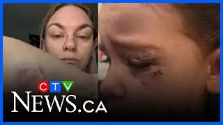 Woman and her daughter attacked by pitbulls in Oshawa