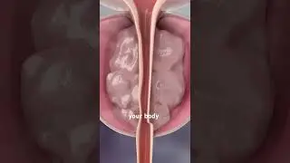 Лечение увеличенной простаты (Rezum и UroLift) 3D-анимация #мочеточник #эндоурология #урологический