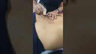Moxibustion & Acupuncture Therapy IMRx @ IM WELL CLINIC Bangalore #moxibustion #acupuncture #imwell