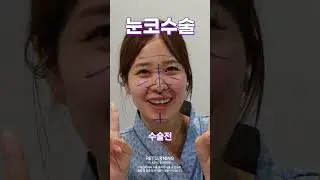 눈+코 성형하면 얼마나 달라지냐고요 보여드림!