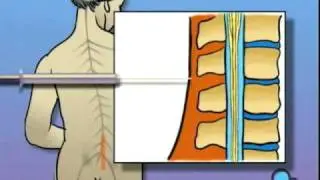 PreOp&reg; Patient Education Spinal  Anesthesia