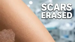 Advancements in Burn Scar Treatment | Pin Holex & Combination Therapy