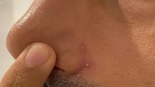 how to get rid of pimples on nose crease