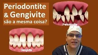 Gengivite É o Começo da Periodontite? Descubra Agora!| Master Pride Odontologia | Dra Bianca Rosa