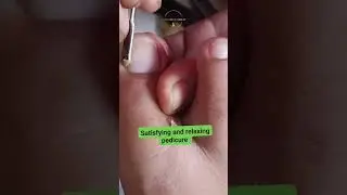 Ingro satisying toenal pedicure  #pedicure  #satisfying #ingrown #fblifestyle #followers