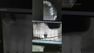How to know the Bone Density by Ondemand software