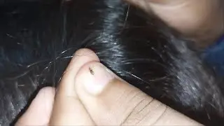 Nitpicking ASMR video 276       #CLOSE-UP #nitpicking #asmr #kuto #piolhos #petantumo  #licepicking
