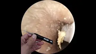 Xyla Ear Wax Removal Kit: Satisfying Deep Clean At Home