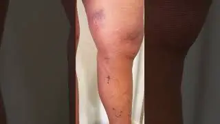 Varizes grossas #aracaju #varizes #sergipe #laser #aracajusergipe #cirurgiaalaser