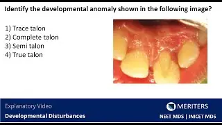 NEET MDS | INICET - Developmental Disturbances | Explanatory Video | MERITERS