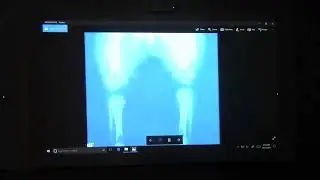 Recognition of Skeletal Dysplasias: Old and New