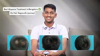 Best Alopecia Treatment in Bengaluru? Are you struggling with Alopecia and severe hair loss?