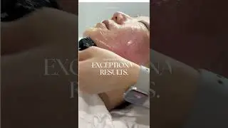 Inmode Minifx Fat reduction & Forma collagen regeneration treatment