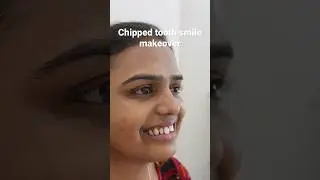 #dentist #veneers #youtubeshorts #mumbai #smilemakeover #beforeafter #india #smile #kshama #dental