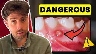 Here&rsquo;s When a Tooth ABSCESS Becomes Dangerous