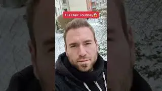 Hair Transplant Journey | Elithair  #shorts