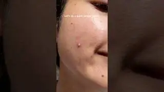 Let&rsquo;s do a quick pimple patch on this juicy pimple 😊 Testing samples of my brand.
