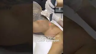 T&uuml;m V&uuml;cut Lazer Epilasyonu