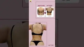 Importance of Markings in Back Liposuction #liposuctionbeforeandafter