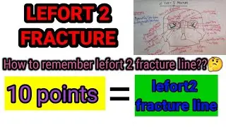 Lefort 2 fracture line|Just in 10 points|Exam ready notes|Lefort 2 fracture