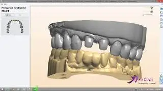 Digital Model Design (3Shape Impression Scan)