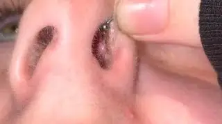 how to get rid of a piercing bump inside your nose fast