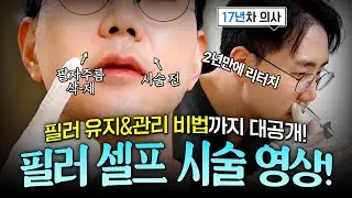 필러 셀프 시술 영상! 천안필러 김영권 원장이 본인에게 직접 하는 안전한 필러 시술법