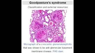Lab or Diagnostic Findings: Goodpasture's Syndrome (glomerulonephritis and hemoptysis)