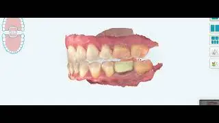 Mandibular Advancement Side Effect