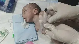 NG Tube Feeding & RBS Check in Newborn Baby | Neonatal Nursing Procedure