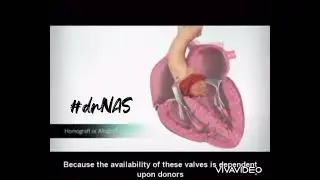 Types of Prosthetic Valves in Heart and their Anticoagulation |Animated Video by drNAS|