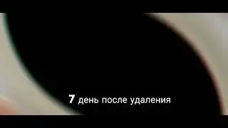 удаление вирусной бородавки лазером I Laser removal of wiral wart