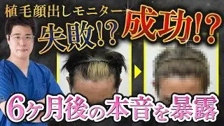 【手術後6ヶ月後インタビュー】顔出しモニターさんの植毛手術に密着