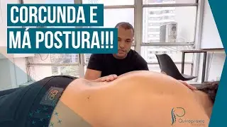 HIPERCIFOSE/CORCUNDA SENDO TRATADO COM QUIROPRAXIA!
