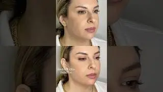 Thinking About Jawline or Chin Filler? WATCH THIS FIRST! 💉✨