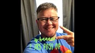 FTM | 2 Years Post Op Top Surgery