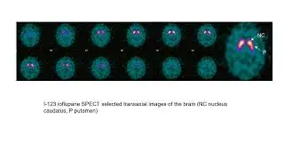 I 123 Ioflupane Dopamine Transporter Imaging DaT Scan