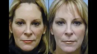 Beauty Industry Expert Undergoes Forehead & Midface Lift