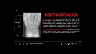 Metabolic Bone Disease