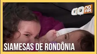 Gêmeas siamesas aguardam cirurgia de separação em Goiânia