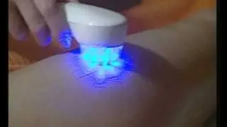 Ultratone Tselluliidiravi (Anti-Cellulite Treatment)