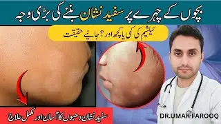 Get Rid of White Spots on Face Forever | ! #whitespots #skin #pityriasisalba